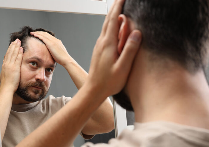 Male Pattern Baldness