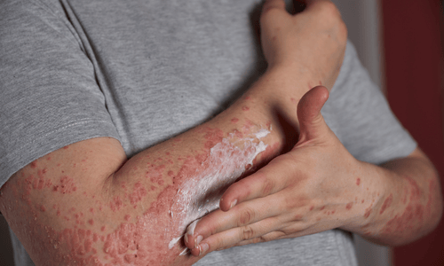 What Is Shingles?