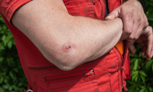 Infected insect bites treatment Manchester