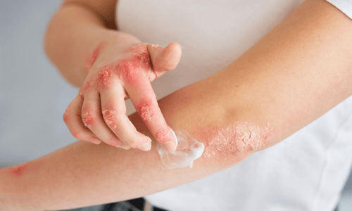 Private shingles treatment Manchester